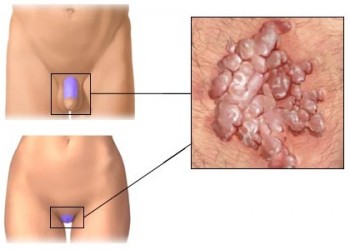 papilloma condilom negii